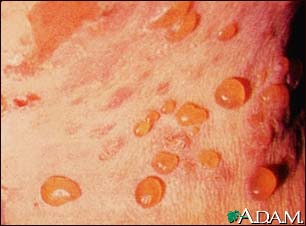 Bullous Pemphigoid - definition and treatment