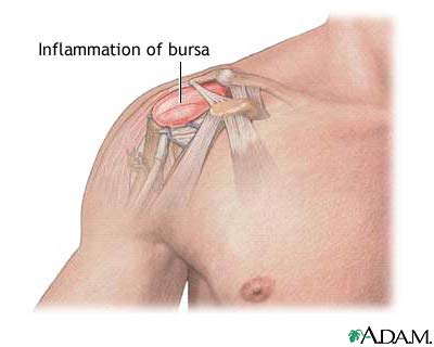 Bursitis - definition, symptoms and treatment