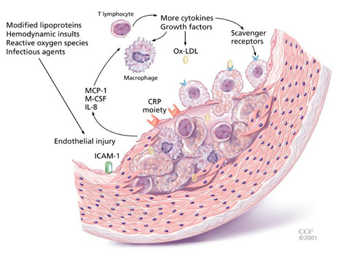 C-Reactive Protein - what is, high levels and lowering