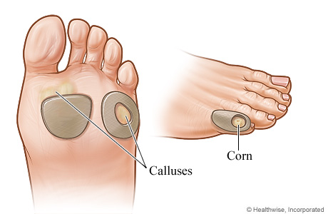 What is Callus - definition, removal and treatment