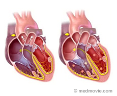 Cardiac Arrest - signs, symptoms and causes