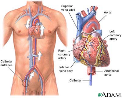 Cardiac Catheterization procedure - definition, complications and risks