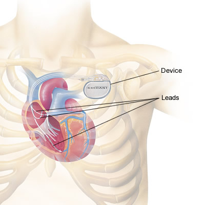 Cardiac Resynchronization Therapy (CRT)