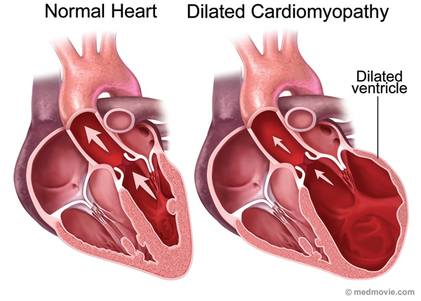 Cardiomyopathy - definition, types, symptoms and treatment