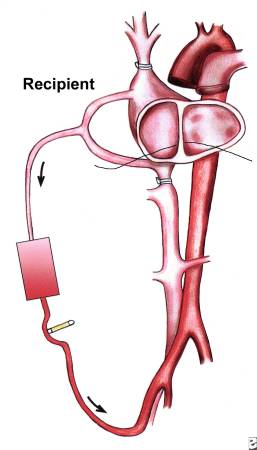 Cardiopulmonary Bypass - machine, definition, history, surgery and complications