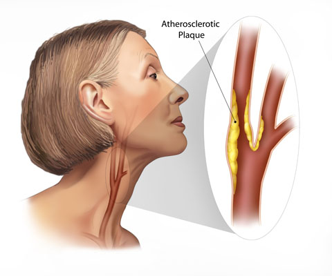 Carotid Bruit sound - definition