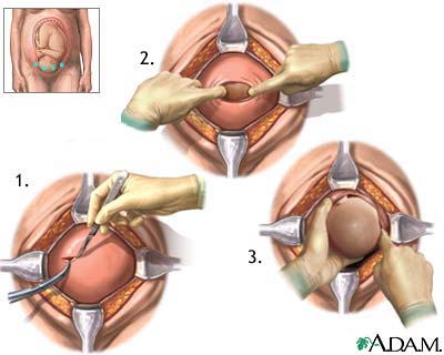 Cesarean Section procedure and complications