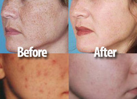 Chemical Peel - light / deep - cosmetic procedure