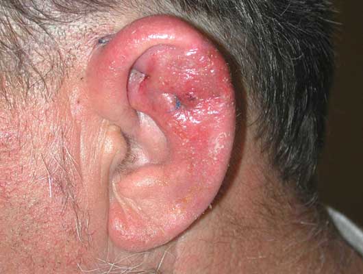 Chondritis - Inflammation of cartilage