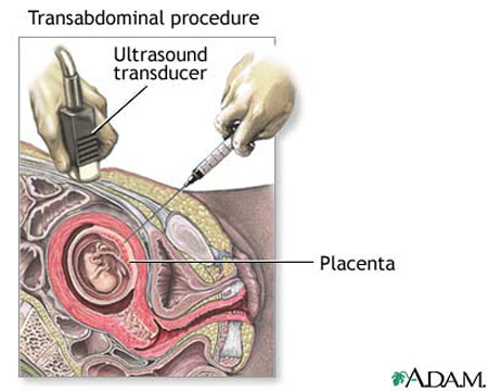 Chorionic Villi Sampling (CVS)