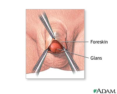Circumcision - surgical removal of the foreskin