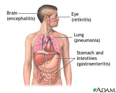 Cytomegalovirus / CMV virus - Symptoms, causes and treatment