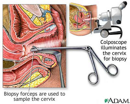 Colposcopy - what is and definition