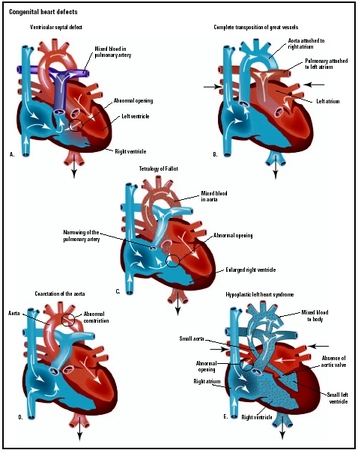 Congenital Heart Disease