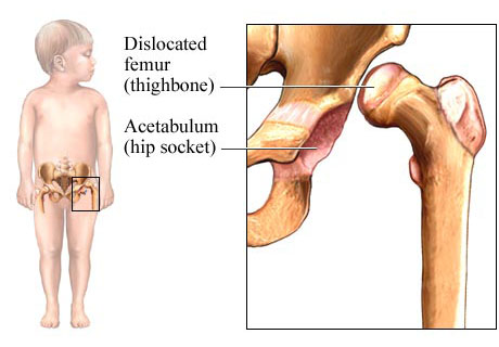 Congenital Hip Dysplasia - in adults and infants