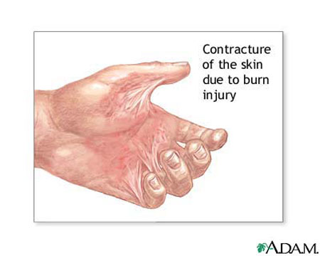 Contracture muscle definition