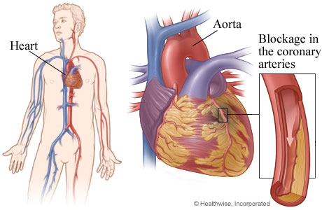 Coronary Artery Bypass Graft (CABG)