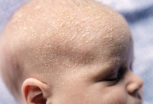 Cradle Cap - what is and treatment