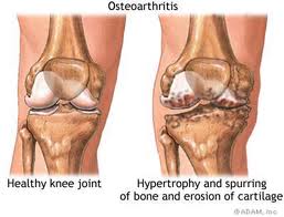 Crepitus definition