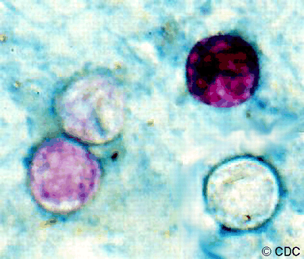 Cyclosporiasis / Cyclospora