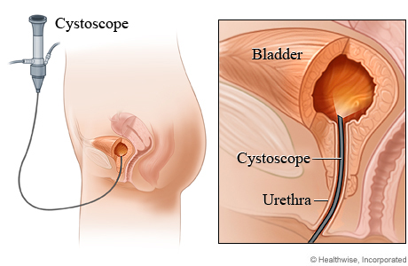 Cystoscopy - endoscopic procedure - what is, definition and application