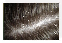 Dandruff - treatment, causes and symptoms
