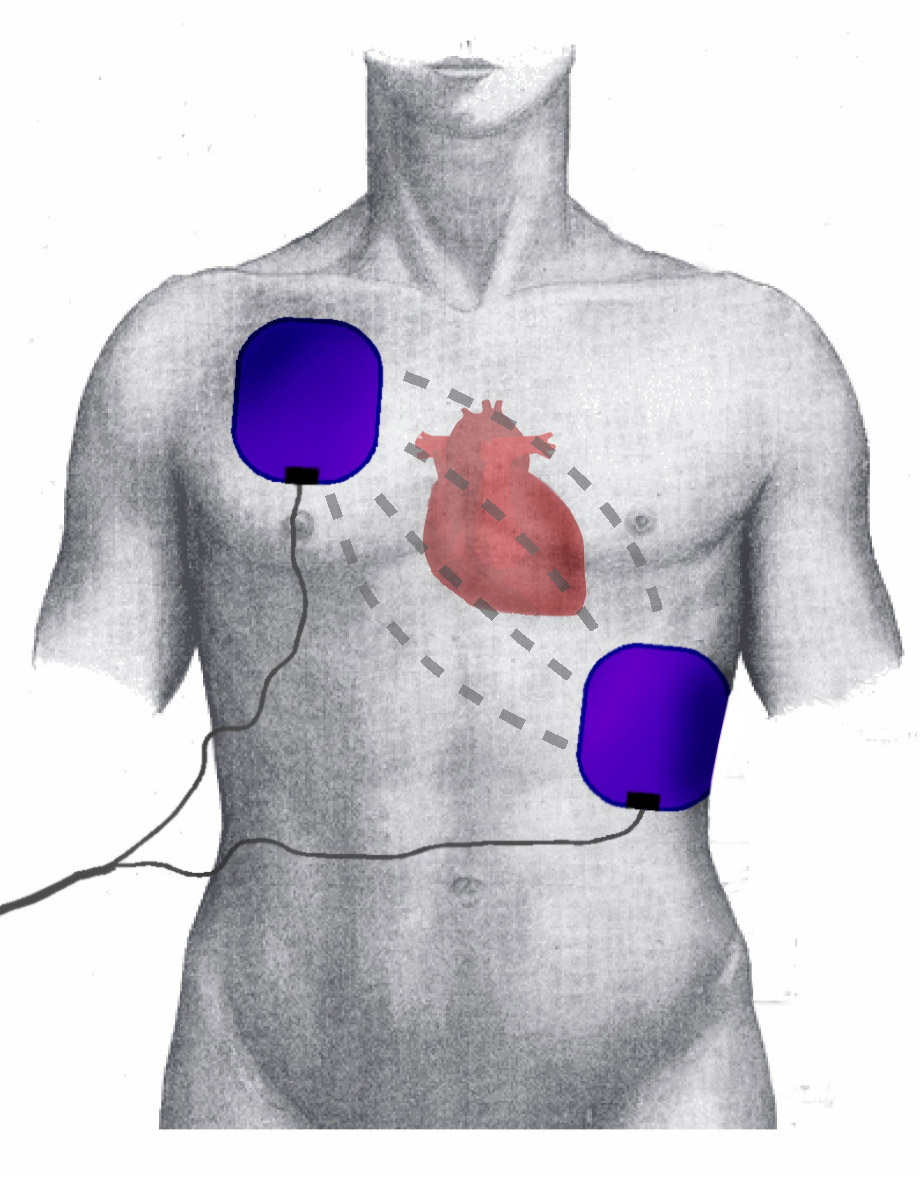 Defibrillation - cardiac arrest, therapeutic method