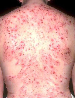 What is Dermatitis - symptoms, treatment