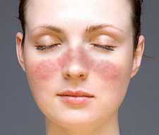 Discoid Lupus Erythematosus (DLE)