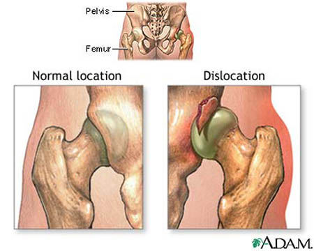 Dislocations of joint and pain