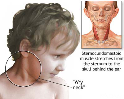 Dystonia disease - treatment and botulinum therapy