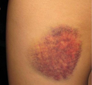 Ecchymosis - bruise - definition and causes