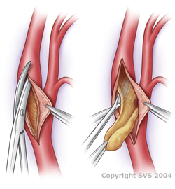 Endarterectomy procedure - carotid artery surgery