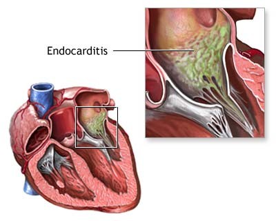 Endocarditis - symptoms, causes and treatment