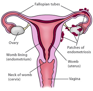 Endometriosis - what is, symptoms, causes and treatment