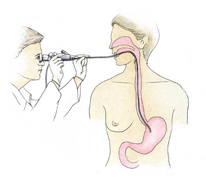 Endoscopy procedure and definition