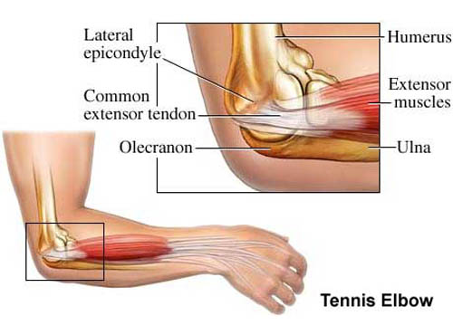 Epicondylitis - Tennis elbow - diagnosis and treatment