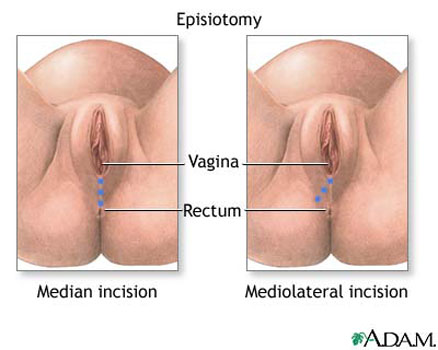 Episiotomy - what is, definition and healing