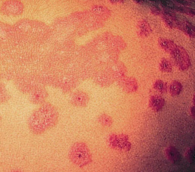 Erythema Multiforme - causes, symptoms and treatment