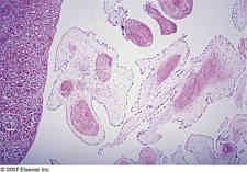 Fibroelastoma papillary - function of the aortic valve