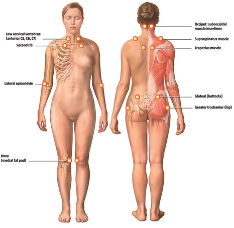 Fibromyalgia - what is, symptoms and treatment