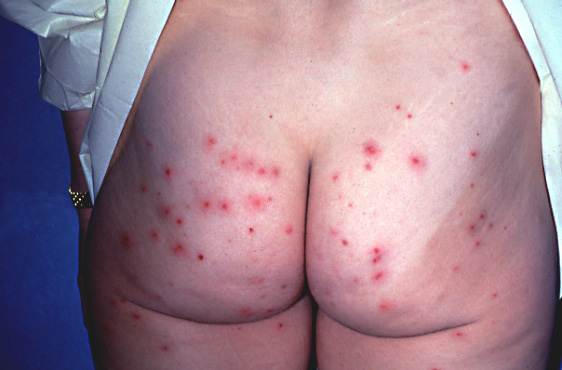 Folliculitis treatment