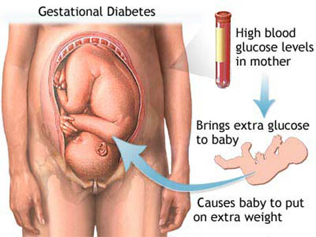 Gestational Diabetes - diet, symptoms, dignosis and treatment