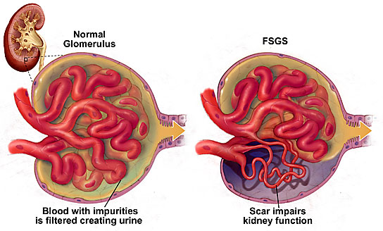 Glomerulosclerosis - symptoms, diagnosis and treatment