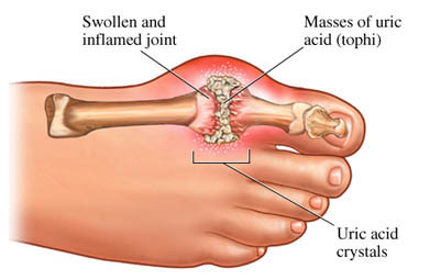 Gout - what is, diet, treatment, causes and symptoms