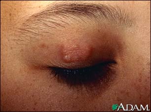 Granuloma - what is and definition