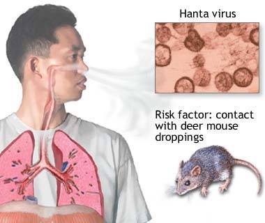 Hantavirus pulmonary syndrome - symptoms and treatment