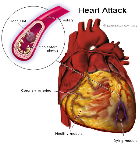 Heart attack - symptoms and treatment