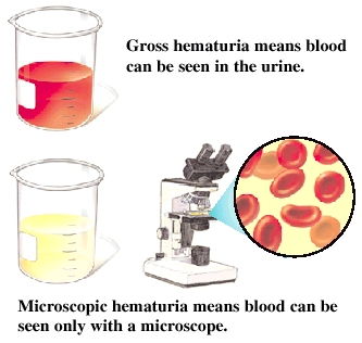 Hematuria - blood in the urine - definition and causes