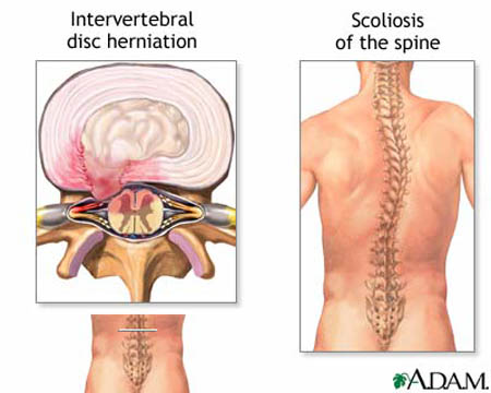 Herniated Nucleus Pulposus - treatment and symptoms